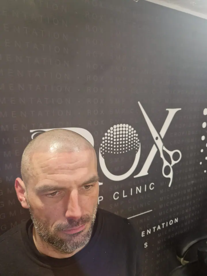 Freshly applied scalp micropigmentation hairline, three-quarter view