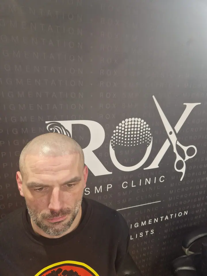 Freshly applied scalp micropigmentation hairline, front view, in front of the salon wall