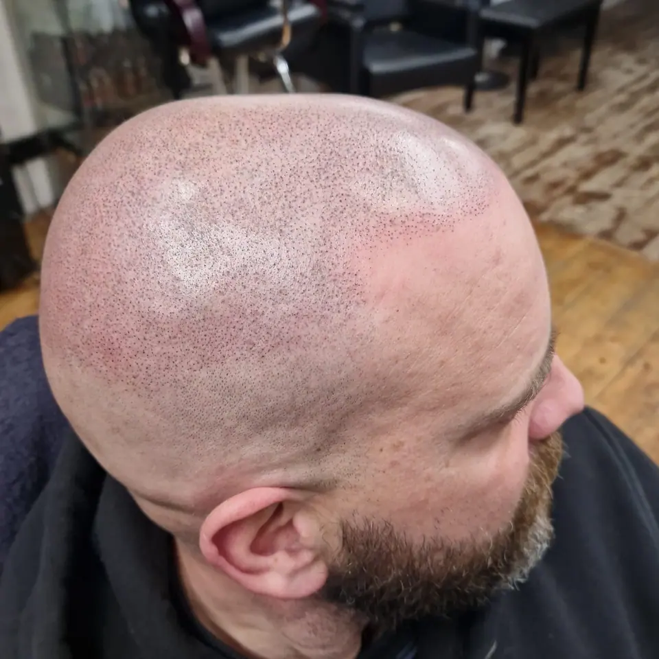 Freshly applied scalp micropigmentation, side view of the scalp