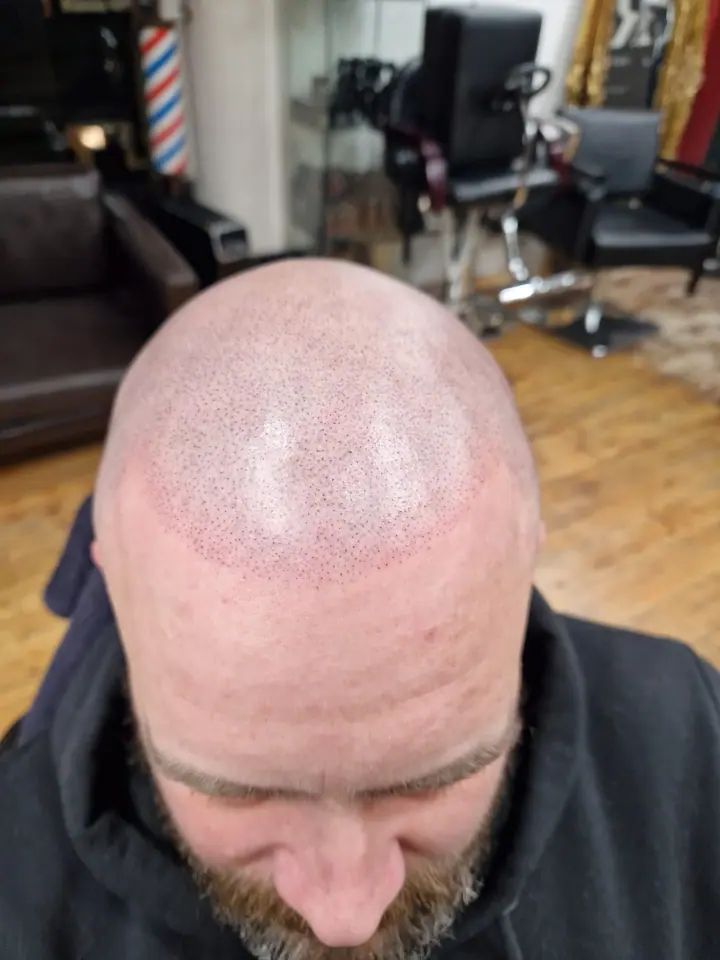 Freshly applied scalp micropigmentation, hairline from above