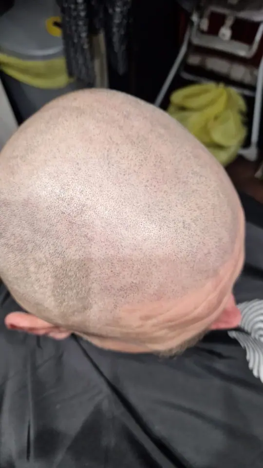 Scalp micropigmentation result, crown from above