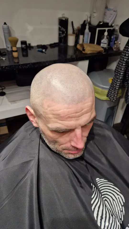 Scalp micropigmentation result, front view, client seated in the salon