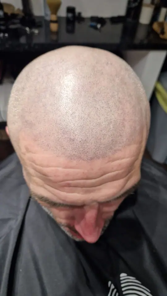 Scalp micropigmentation result, hairline from above