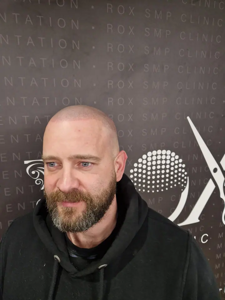 Scalp micropigmentation client in front of the salon wall, looking left