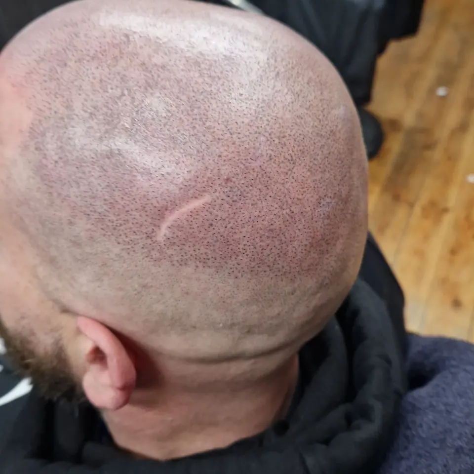 Scalp micropigmentation around a curved scar on the crown, close-up
